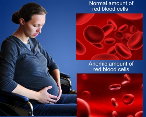 Diet Anaemia In Pregnancy