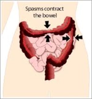 spasms contract the colon in IBS