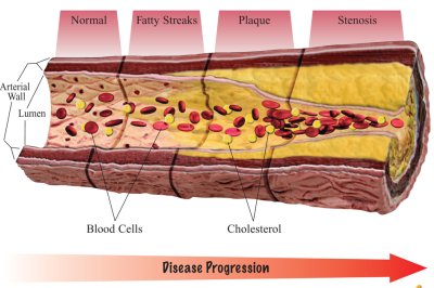 oxidized cholesterol leads to atherosclerosis